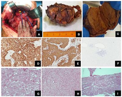 Composite Paraganglioma of the Celiac Trunk: A Case Report and a Comprehensive Review of the Literature